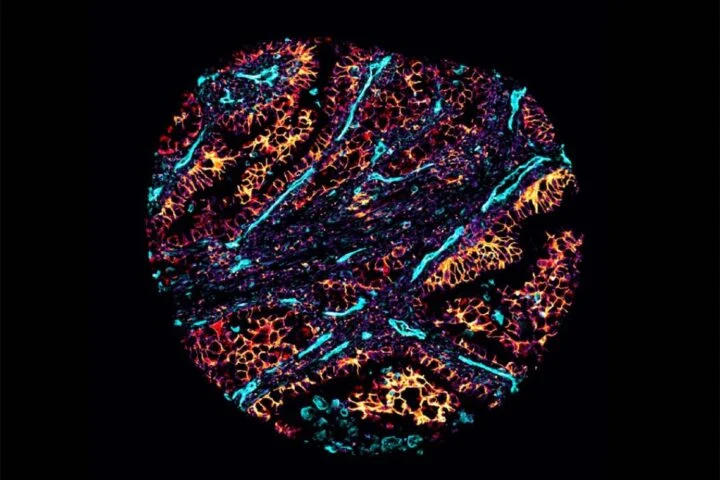 Trí tuệ nhân tạo giúp dự đoán hiệu quả điều trị ung thư phổi